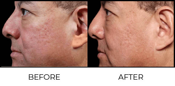 What is Exion Face (BTL)? Before & After 1
