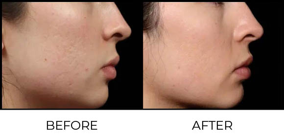 What is Exion Face (BTL)? Before & After 2
