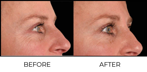 What is Exion Face (BTL)? Before & After 3