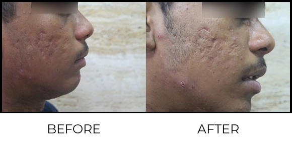 Exion MNRF (BTL) Before & After 1