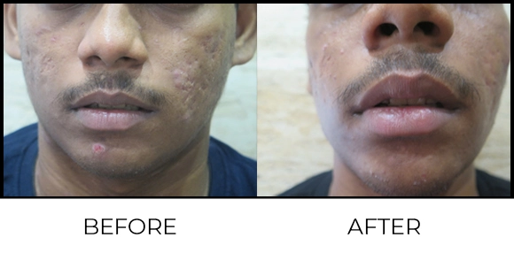 Exion MNRF (BTL) Before & After 2