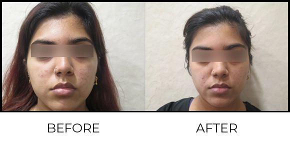 Exion MNRF (BTL) Before & After 3
