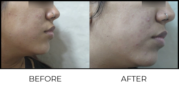 Exion MNRF (BTL) Before & After 4