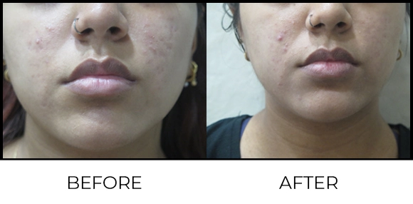Exion MNRF (BTL) Before & After 5