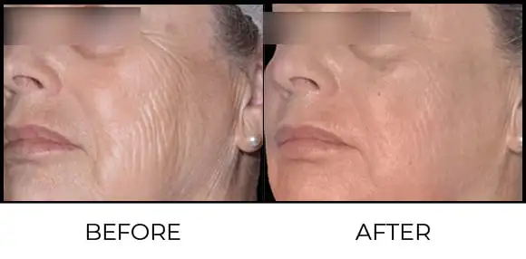 Exion MNRF (BTL) Before & After 6