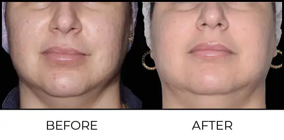 Exion MNRF (BTL) Before & After 7