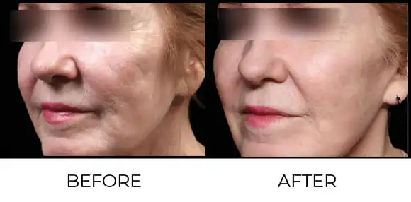 Exion MNRF (BTL) Before & After 8