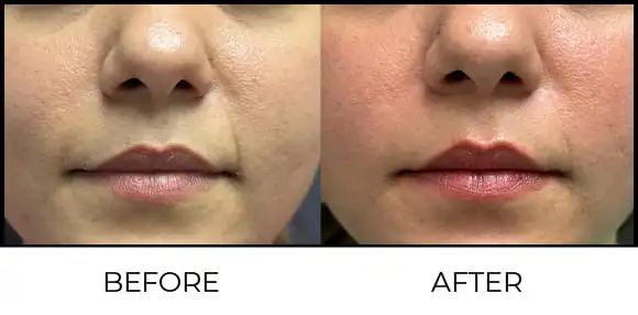 Exion MNRF (BTL) Before & After 9