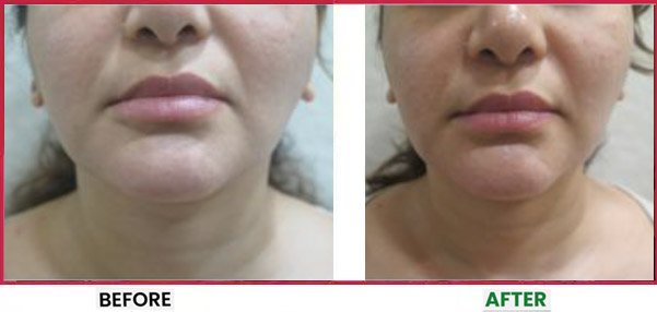 HIFU Before & After 1