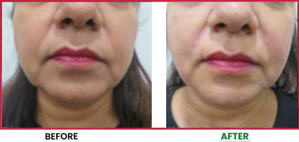 HIFU Before & After 2