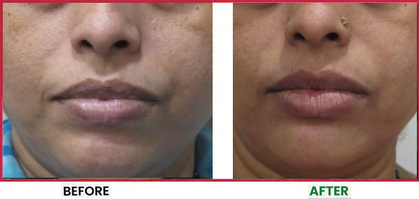 HIFU Before & After 3