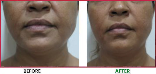HIFU Before & After 4