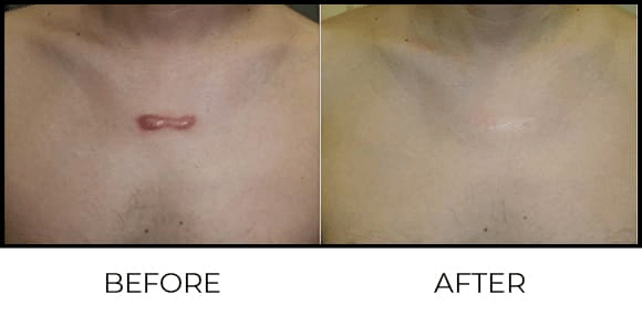 Keloid Treatment - Kenacort Before & After 6