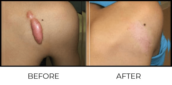 Keloid Treatment - Kenacort Before & After 8