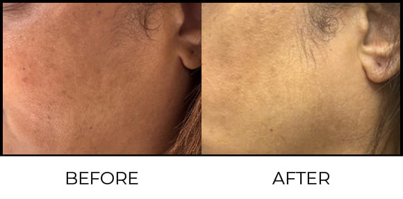 Fotona Laser Before & After 1