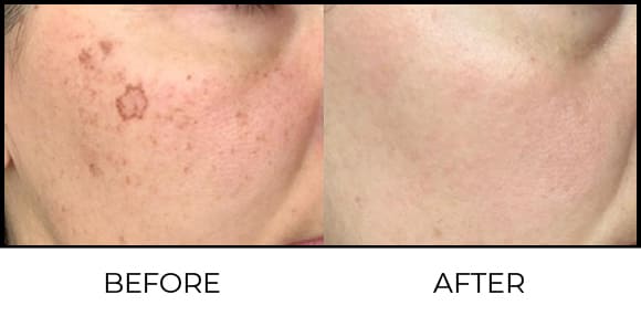Fotona Laser Before & After 2