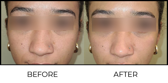 Medi-Facial Before & After 1