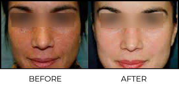 Medi-Facial Before & After 2