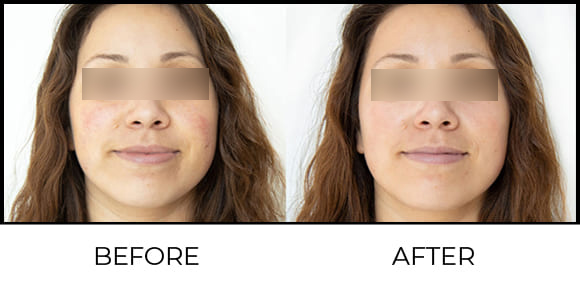 Medi-Facial Before & After 3