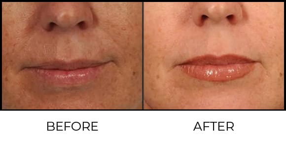 Micro Dermabrasion Before & After 1