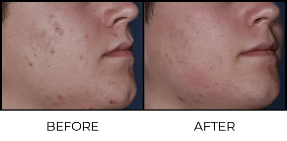 Micro Dermabrasion Before & After 2