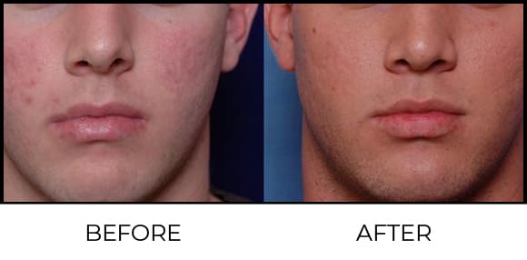 Micro Dermabrasion Before & After 3