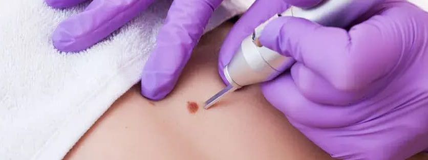 Mole Removal Before & After 5