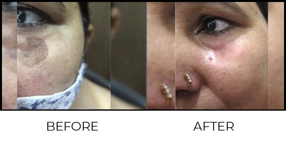 Mole Removal Before & After 6