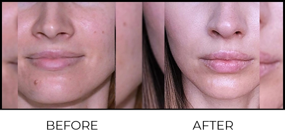 Mole Removal Before & After 7