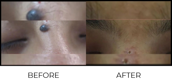 Mole Removal Before & After 8