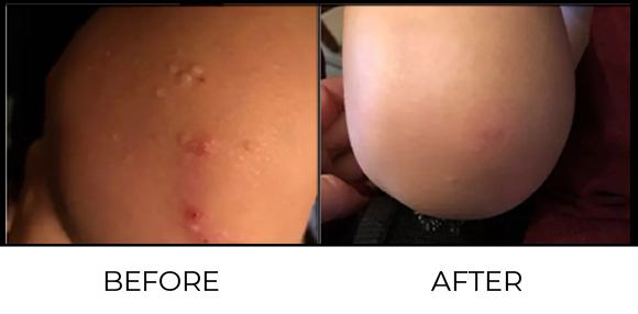 Molluscum Removal Before & After 1