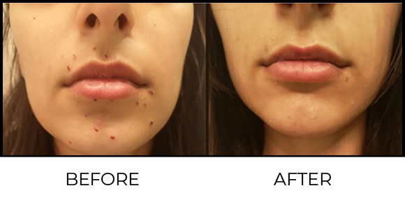 Molluscum Removal Before & After 2