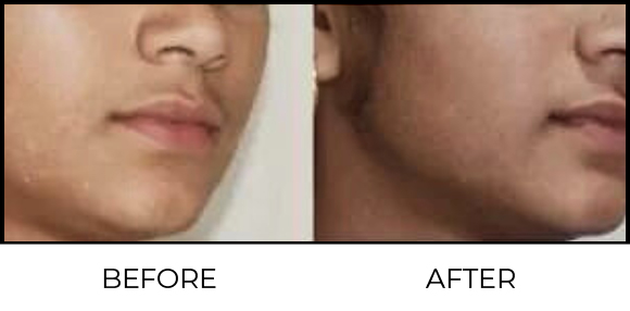 Molluscum Removal Before & After 3