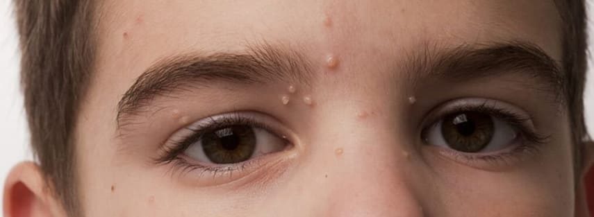 Molluscum Removal at Skuccii Supercliniq