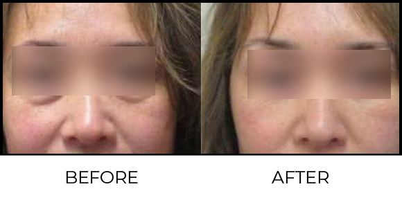 Plasma Pen Before & After 1
