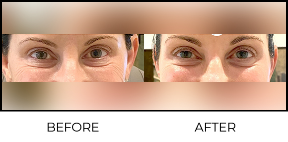 Plasma Pen Before & After 2