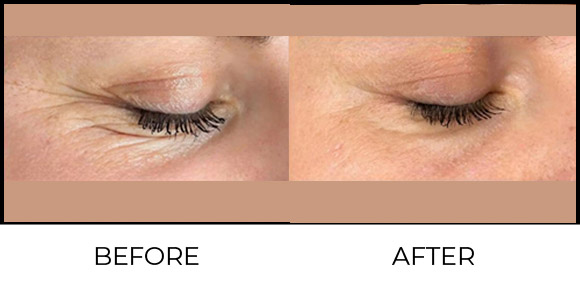 Plasma Pen Before & After 3