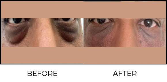 Plasma Pen Before & After 4
