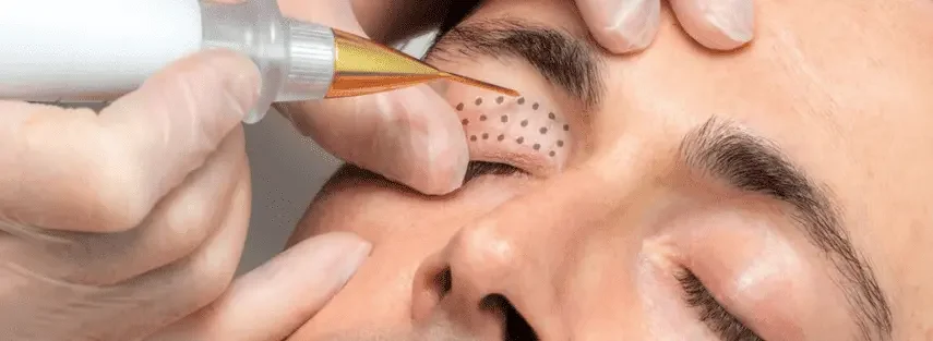 Plasma Pen Treatment at Skuccii Supercliniq