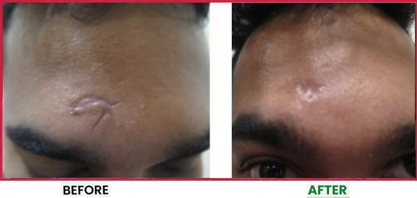 Acne Scar Treatment Before & After 1