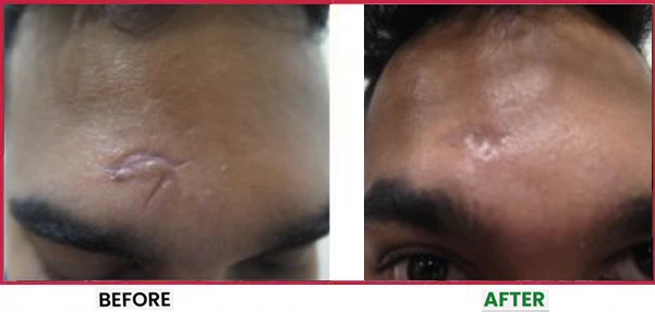Acne Scar Treatment Before & After 1