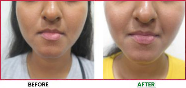 Acne Scar Treatment Before & After 2
