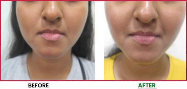 Acne Scar Treatment Before & After 2