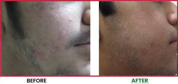 Acne Scar Treatment Before & After 3