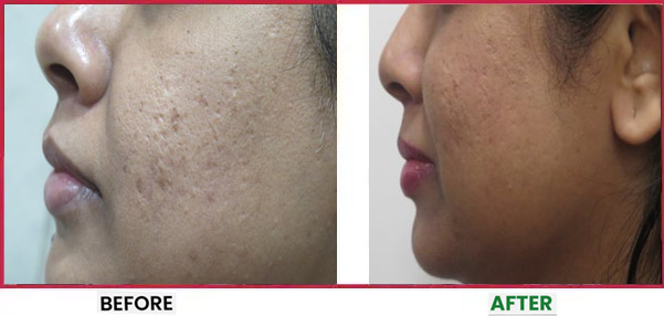 Acne Scar Treatment Before & After 4