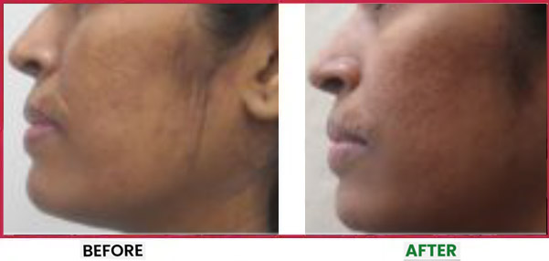 Acne Scar Treatment Before & After 5