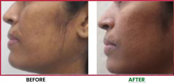Acne Scar Treatment Before & After 5