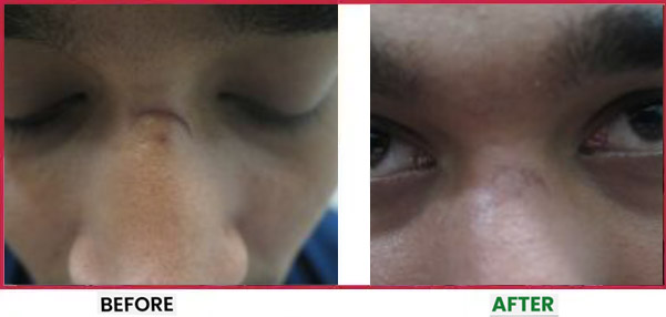 Acne Scar Treatment Before & After 6