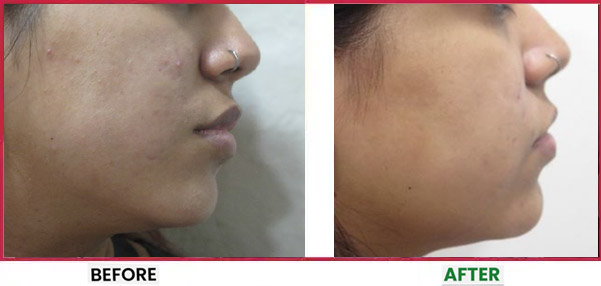 Acne Scar Treatment Before & After 7