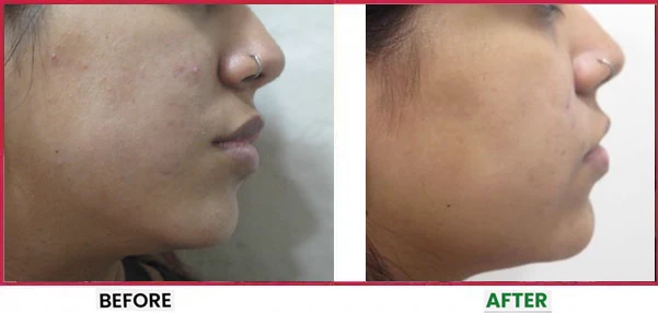 Acne Scar Treatment Before & After 7
